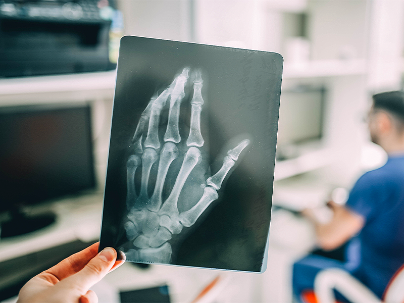 Recovering from Hand Surgery: What You Need to Know